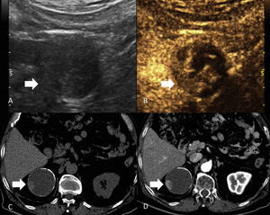Carcinoma de células renales quístico categoría Bosniak 4 en 2 pacientes diferentes. Se muestran nódulos sólidos intraquísticos que realzan tras inyectar medio de contraste (flechas); el primer paciente estudiado mediante ecografía (A y B) y el segundo mediante TCMD (C y D).