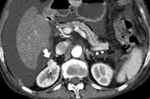 Angiomiolipoma pobre en grasa. TCMD en fase corticomedular. Nódulo sólido cortical derecho (flecha) realzado, sin grasa reconocible, indistinguible de un carcinoma de células renales.