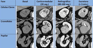 Patrones orientativos de realce en los principales subtipos del carcinoma de células renales mediante TCMD.