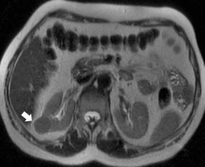 Carcinoma de células renales cromófobo estudiado con RM (T2 FSE): nódulo cortical derecho sólido homogéneo e hipointenso respecto al parénquima renal (flecha); los tumores papilares y angiomiolipomas pobres en grasa pueden también ser hipointensos en T2.