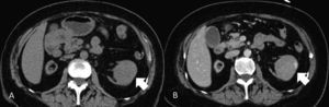 Carcinoma renal tubular mucinoso y de células fusiformes. A) TCMD en fase basal. Nódulo sólido cortical izquierdo (flecha). B) TCMD en fase nefrográfica. El nódulo realza moderadamente (flecha), con un aspecto indistinguible de otras formas de carcinoma de células renales.