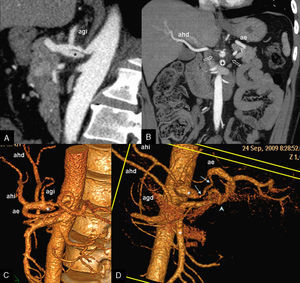 Caso 1. TC con contraste IV. A) Reconstrucción sagital oblicua en el plano del tronco celiaco. B) Reconstrucción coronal MIP de grosor fino. C) Reconstrucción volumétrica, visión oblicua izquierda. D) Reconstrucción volumétrica, visión frontal oblicua en el estudio de seguimiento realizado 82 días después. Se aprecia un defecto íntimo-medial a 20mm de distancia del origen del tronco celiaco, con un flap que se propaga proximalmente desde este defecto con longitud de 14mm. Queda una luz falsa sacular inferior (asteriscos) y una luz verdadera superior, con calibre marcadamente reducido. Las flechas huecas en B señalan al halo periarterial de sutil aumento de densidad de la grasa, probablemente responsable del intenso dolor del paciente. En el estudio de control se aprecia mayor dilatación de la luz falsa, con estenosis del tramo proximal de la arteria esplénica (flechas blancas), suplida distalmente por rama de la mesentérica superior (cabeza de flecha). +: arteria mesentérica superior; Ae: arteria esplénica; Agd: arteria gastroduodenal; Agi: arteria gástrica izquierda; Ahd: arteria hepática derecha, con origen en AMS (variante anatómica); Ahi: arteria hepática izquierda, con origen en TrC.