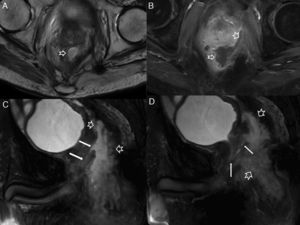 Absceso posquirúrgico complicado con una fístula a la uretra prostática en un paciente de 49 años con antecedente de radio-quimioterapia antes de la amputación abdominoperineal. A) Imagen axial potenciada en T2. B) Imagen axial potenciada en T1 con supresión grasa tras la administración de contraste iv. C y D) Imágenes sagitales potenciadas en T2 con supresión grasa. Las flechas huecas indican a un voluminoso absceso sobre el lecho quirúrgico de la amputación abdominoperineal. Las flechas sólidas señalan la fístula que comunica con la uretra prostática.