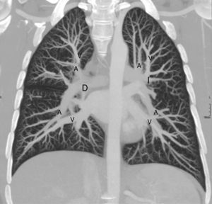 Vascularización pulmonar normal. Reconstrucción coronal en modo MIP (proyección de máxima intensidad) de una TC de tórax con contraste iv. Distribución arboriforme de la vascularización pulmonar desde los hilios (hilio derecho [D] e hilio izquierdo [I]). Habitualmente las venas pulmonares (V) se sitúan lateralmente a las arterias (A) en los lóbulos superiores y mediales en las bases pulmonares. Como la TC se realiza en decúbito supino el gradiente apicobasal del flujo pulmonar por la gravedad no se puede apreciar.