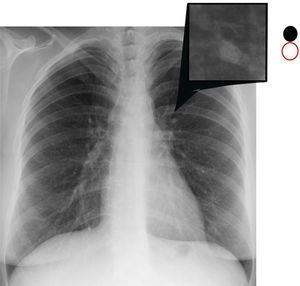 «Signo del binocular o del gemelo». Radiografía de tórax posteroanterior de la misma paciente que en la figura 1. En el cuadro ampliado se aprecia que el bronquio y el vaso tienen un calibre muy similar.