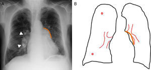 Patrón de hipertensión pulmonar arterial. A. Radiografía de tórax posteroanterior de un paciente con EPOC. Crecimiento de la arteria pulmonar principal (remarcada en naranja) y de los hilios, más el derecho (puntas de flecha blancas). La vascularización pulmonar periférica está disminuida en número y calibre. B. Esquema del patrón de hipertensión pulmonar. Aumento típico de tamaño de los vasos pulmonares centrales con prominencia de la arteria pulmonar principal (línea naranja) y amputación de los vasos periféricos.
