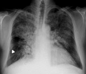Edema agudo de pulmón. Radiografía de tórax posteroanterior de un paciente con síntomas de insuficiencia cardiaca aguda. El patrón de redistribución vascular queda enmascarado por el edema agudo de pulmón, consistente en áreas de consolidación bilaterales, simétricas y de predominio central (con forma característica en «alas de mariposa»). También se aprecia cardiomegalia y pequeño derrame pleural bilateral. Incidentalmente se observa un callo de fractura en la 8.a costilla derecha (punta de flecha).