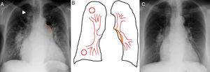 Patrón de plétora pulmonar. A. Radiografía de tórax posteroanterior de una paciente con comunicación interauricular (CIA). Aumento difuso, bilateral y simétrico del tamaño de los vasos pulmonares que afecta tanto a los hilios como a la periferia. La arteria pulmonar principal está aumentada de tamaño (remarcada en naranja). Se observa también cardiomegalia global. Lóbulo de la ácigos como variante anatómica (punta de flecha). B. Esquema del patrón de plétora. C. Radiografía de tórax posteroanterior de la misma paciente tras el cierre de la CIA con un dispositivo tipo Amplatzer. Disminución de la plétora pulmonar y de la cardiomegalia.