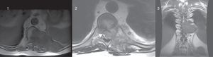Resonancia magnética: 1) Plano axial en una secuencia potenciada en T1. La tumoración vertebral y costal tiene una señal algo heterogénea, predominantemente intermedia, con algunas zonas de mayor señal. 2) Plano axial en una secuencia potenciada en T2. La señal de la tumoración es también heterogénea, predominantemente intermedia, con focos de mayor señal. El componente intrarraquídeo del tumor (flecha) comprime y desplaza a la médula dorsal, que muestra un aumento de su señal por mielopatía compresiva. 3) Plano coronal en una secuencia potenciada en T1. Se identifica la extensión paravertebral de la tumoración, que oblitera los agujeros de conjunción izquierdos D8-D9, D9-D10 y D10-D11.