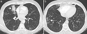 Aspergilosis broncoinvasiva en una mujer de 77 años con leucemia linfática crónica y neutropenia grave (270 neutrófilos/mm3). En la TCMD se ve un área de consolidación focal con broncograma aéreo en el lóbulo medio (flecha blanca) (a) y múltiples nódulos centrolobulillares ramificados en ambas bases (flechas blancas) (b). El cultivo de esputo fue positivo para Aspergillus.