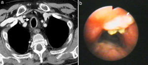 Traqueobronquitis aguda por Aspergillus confirmada por broncoscopia en un varón de 52 años portador de trasplante renal. Imágenes axiales de TCMD con contraste intravenoso con ventana de mediastino (a) donde se aprecia un engrosamiento circunferencial de la pared de la tráquea (flecha blanca). Imagen de broncoscopia (b) en la que se observan varias lesiones nodulares blanquecinas sobreelevadas en la pared de la tráquea que correspondían a zonas de crecimiento endobronquial de Aspergillus que se asociaban a densos tapones mucosos.