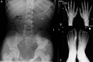 A) Radiografía simple de abdomen. Hiperostosis compacta de la pala ilíaca izquierda y del hueso púbico (flechas negras). Hiperostosis parcheada de los cuerpos vertebrales, apófisis espinosas y pedículos izquierdos de D11-L4 y S3 (entre los asteriscos). Calcificaciones lineales y heterogéneas bilaterales sobre las siluetas renales (flechas blancas). B) Radiografía de las manos que muestra afectación irregular excéntrica del tercer al quinto metacarpianos y falanges proximales y medias de la mano izquierda. C) Afectación irregular y compacta del primer y quinto metatarsianos izquierdos y de las falanges del pie izquierdo.