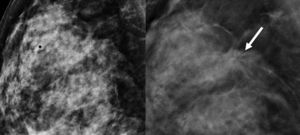 Estudio comparativo: mamografía convencional (izquierda) y tomosíntesis (derecha). Nódulo espiculado asociado a microcalcificaciones, muy sospechoso de malignidad, que no se observa en el estudio convencional de mamografía y sí en el de tomosíntesis (flecha blanca). Diagnóstico anatomopatológico: carcinoma ductal infiltrante.