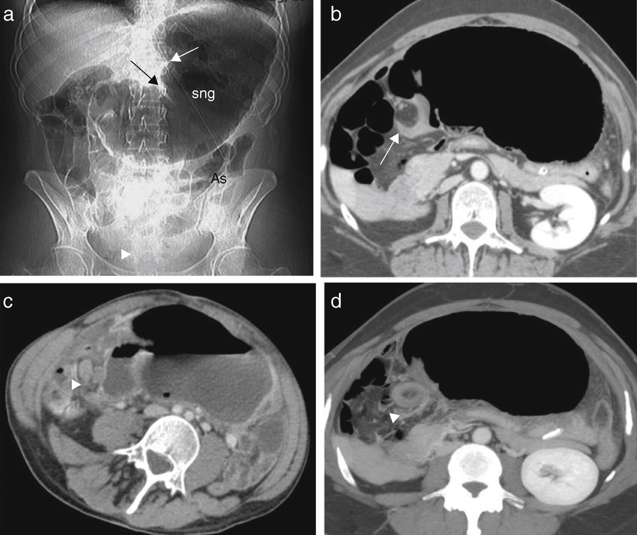 Volvulus Cec Rx Vólvulos del tracto gastrointestinal. Diagnóstico y correlación entre ...