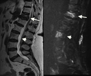 Paciente con neoplasia pulmonar. Fractura metastásica en T12 (flecha) y lesión metastásica en L3 (cabeza de flecha). Ambas lesiones son hipointensas en las imágenes potenciadas en T2 (izquierda) y marcadamente hiperintensas en las potenciadas en difusión (derecha).