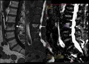 Paciente con nódulo de Schmörl (flecha). La lesión es hipointensa en la imagen potenciada en T1 (izquierda) e hiperintensa en STIR (centro) y en la imagen potenciada en difusión (derecha).