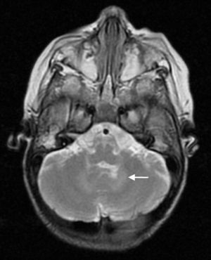 Diagnóstico diferencial de la afectación de la sustancia blanca cerebelosa. Niño de 3 años con retraso severo del desarrollo. RM axial FSE T2. Alteración bilateral y simétrica de la señal de la sustancia blanca profunda del cerebelo (flecha). Este paciente presentaba una leucopatía hipomielinizante.