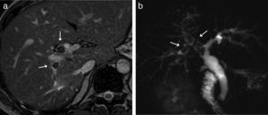 Litiasis intrahepáticas. RM eco de gradiente T2 transversal del hígado (A) e imagen coronal de colangio-RM 2D (B) que muestran lesiones intraductales hipointensas (flechas) de bordes lisos y angulados en el conducto hepático derecho y conductos secundarios correspondientes a litiasis.
