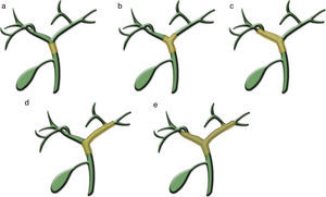 Ilustraciones que representan los tipos de crecimiento longitudinal del colangiocarcinoma perihiliar según el sistema modificado de Bismuth-Corlette. A) Tipo I. Afecta al conducto hepático común. B) Tipo II. Afecta a la confluencia de los conductos hepáticos. C y D) Tipo III. Afecta a la confluencia de conductos secundarios del conducto hepático derecho (IIIa) o izquierdo (IIIb). E) Tipo IV. Afecta a ambos conductos hepáticos y a las confluencias secundarias de ambos o a niveles múltiples y discontinuos bilateralmente.