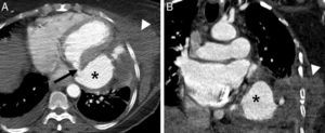 TC torácica con contraste intravenoso en reconstrucciones axial (A) y coronal (B). Cavidad rellena de contraste (asteriscos en A y B) que comunica con el ventrículo izquierdo a través de un defecto en la pared miocárdica adyacente al surco aurículo-ventricular (flecha en A). Se observa un gran hematoma asociado con extensión lateral hacia la pared torácica (cabezas de flecha en A y B).