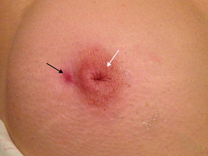 Fístula paraareolar externa en la mama derecha en una paciente de 30 años (flecha negra). El pezón está invertido (cabeza de flecha).