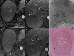a y b) Imágenes axiales de RM potenciada en T1 tras inyectar gadolinio (fase arterial). Se observan 3 hepatocacinomas de 30, 20 y 20mm (flechas). c) Angiografía hepática (fase tardía) en la que se observan los tumores (flechas). d y e) Imágenes axiales de RM potenciada en T1 tras inyectar gadolinio (fase arterial). Respuesta parcial tras una sesión de quimioembolización transarterial selectiva con microesferas de hidrogel precargadas con doxorrubicina (QETA-DEB) en los 3 hepatocarcinomas (flechas), que han disminuido de tamaño pero realzan periféricamente. f) Imagen microscópica (H&E 10x) de uno de esos tumores, a los 10 meses de la QETA-DEB. Necrosis central (N) del 70% con un halo periférico de viabilidad tumoral (★).