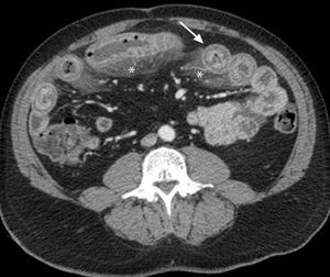 TC abdominal con contraste intravenoso, imagen axial. Engrosamiento con estratificación mural (flecha) de un segmento largo de yeyuno e íleon, y edema mesentérico (asterisco).
