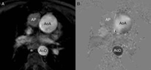 Imagen de magnitud (A) y de fase (B) en una adquisición de contraste de fase en el tronco de la arteria pulmonar. En la imagen de fase, el flujo ascendente es blanco y el descendente es negro. AoA: aorta ascendente; AoD: aorta descendente; AP: arteria pulmonar.