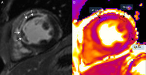 Resonancia magnética en un paciente con extenso infarto transmural anterior y septal, en un equipo de 3T (Magnetom Trio-Tim, Siemens, Erlangen, Germany). A) Secuencia de realce tardío con gadolinio donde puede observarse la obstrucción microvascular (flechas blancas). B) Mapa de T2 donde puede observarse cómo el área de obstrucción microvascular presenta un tiempo de T2 menor (41ms) que el edema (58ms); el miocardio remoto de la cara lateral tiene un valor de T2 de 44ms (el valor normal de T2 del miocardio es de 49±3ms).