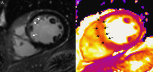 Paciente con infarto agudo de miocardio a nivel septal, en un equipo de 3T (Magnetom Trio-Tim, Siemens, Erlangen, Germany). A) Secuencia de realce tardío con gadolinio que muestra un realce subendocárdico (flechas). B) En el mapa de T2 puede observarse cómo el área de edema (flechas) es más extensa que el infarto, lo que permite determinar el miocardio en riesgo.