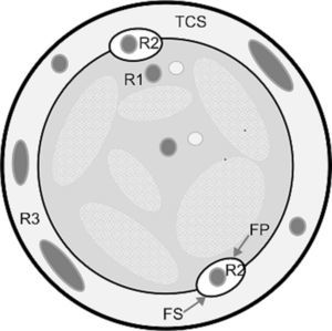 Sección axial de miembro inferior izquierdo. R1: sistema venoso profundo. R2: sistema venoso superficial. R3: colaterales. FP: fascia profunda; FS: fascia superficial; TCS: tejido celular subcutáneo.