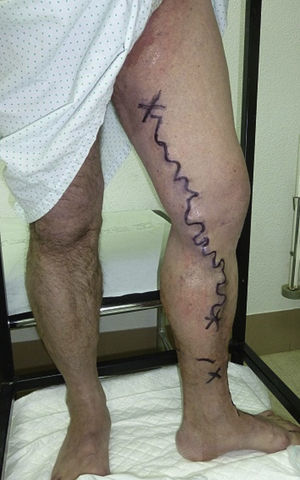 Marcaje prequirúrgico.