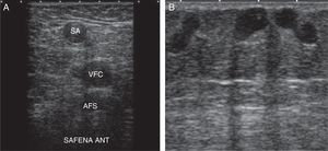 A) La vena safena anterior ocupa una posición anterior con respecto a los vasos profundos. B) Red terciaria en tejido celular subcutáneo. AFS: arteria femoral superficial; SA: safena anterior; VFC: vena femoral común.