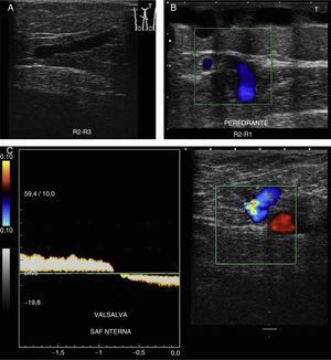 A) Punto de fuga. B) Punto de entrada. C) Reflujo.
