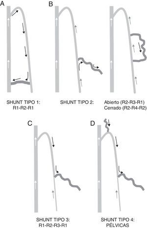 Tipos de shunts. A) Tipo 1. B) Tipo 2. C) Tipo 3. D) Tipo 4.