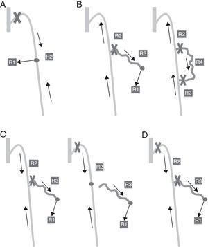 A) CHIVA 1 en shunt tipo 1. B) CHIVA 1 en shunt tipo 2. C) CHIVA 2 en tipo 3. D) CHIVA 1+2.
