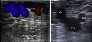 A) Reflujo con Doppler color (maniobra de Valsalva). B) Signo del Mickey Mouse. AFC: arteria femoral común; VFC: vena femoral común; VSI: vena safena interna.