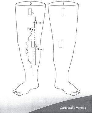 Ejemplo de cartografía en papel shunt tipo 3.
