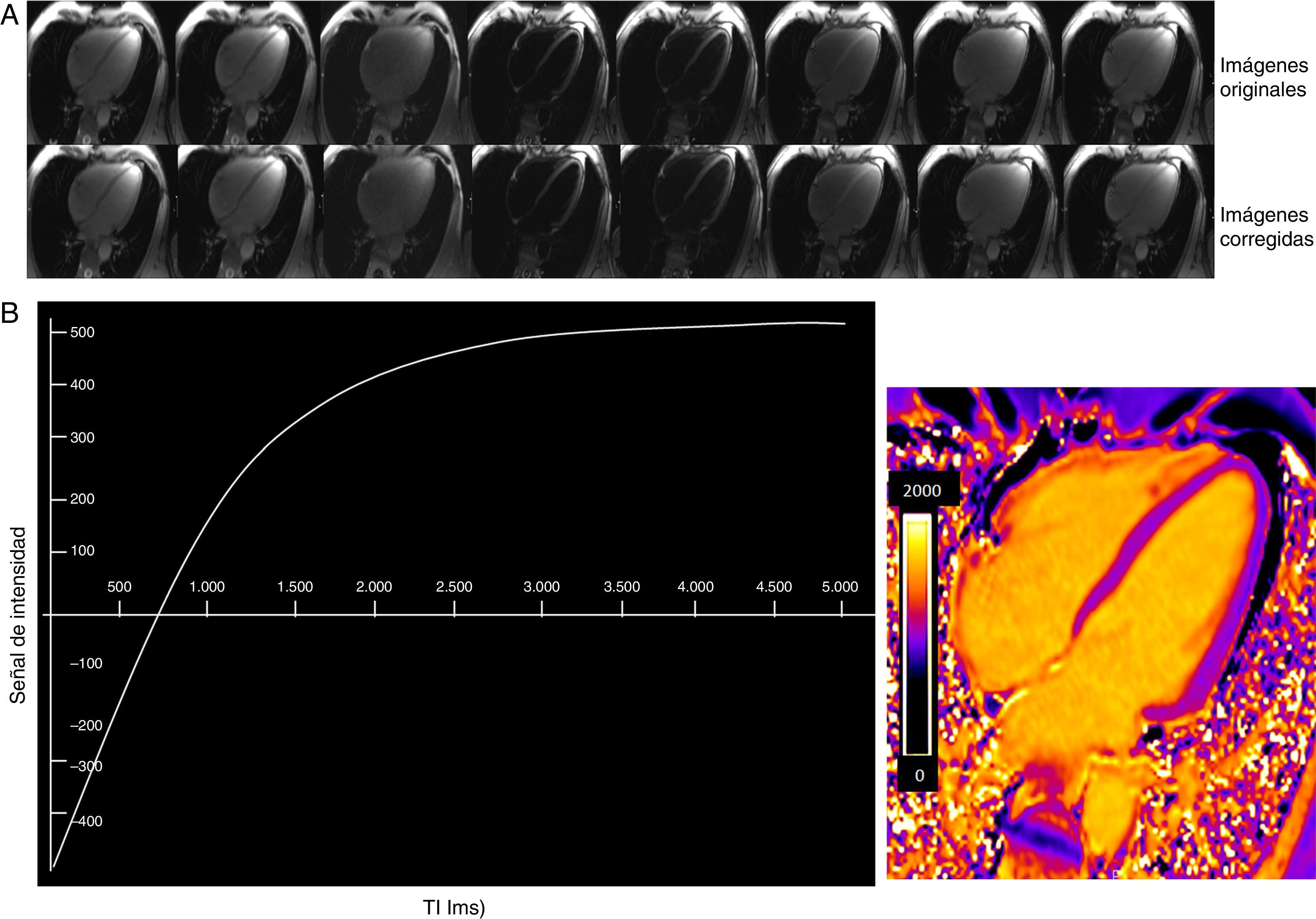 Inversion Locker Técnicas paramétricas de caracterización tisular del miocardio mediante ...