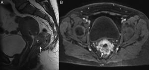 Cáncer de cérvix con invasión rectal (estadio FIGO IVA) en una mujer de 44 años. En las secuencias turbo espín eco T2 sagital (A) y T1 con contraste y supresión grasa axial (con un tiempo de retardo de 1min) (B) se observa una masa (T) que se extiende posteriormente infiltrando la reflexión peritoneal, la grasa mesorrectal y la pared anterior del recto medio (flechas).