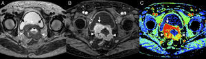 Cáncer de cérvix con invasión vesical (estadio FIGO IVA) en una mujer de 58 años. En la secuencia turbo espín eco T2 axial (A) se observa una gran masa (T) que invade ambos parametrios (puntas de flecha) y la pared vesical posterior (flecha blanca). Se visualiza el extremo inferior de los catéteres doble J (flecha negra) implantados por la ureterohidronefrosis que presentaba la paciente, ya que la lesión invadía ambas desembocaduras ureterovesicales. En un corte discretamente caudal al anterior se observa un intenso realce en el tumor y en la cara posterior de la pared vesical en la secuenciaT1 axial con contraste y supresión grasa (con un tiempo de retardo de 3min) (B), así como aumento de los valores a dicho nivel en el mapa paramétrico de perfusión correspondiente al área bajo la curva a 90 segundos (C).