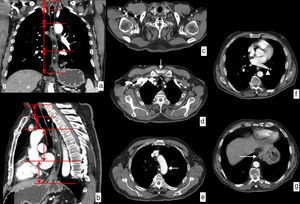 Límites y relaciones anatómicas del esófago en TC. Se ha administrado agua como contraste oral negativo, que rellena la luz esofágica (*) discretamente dilatada por una neoplasia esofágica en el tercio distal visualizada en las imágenes (flechas huecas). a) Vista coronal de reconstrucción curva siguiendo el eje del esófago. Las líneas rojas horizontales representan los límites de cada uno de los segmentos en que se divide el esófago. b) Vista sagital de reconstrucción curva siguiendo el eje del esófago que muestra la misma información. c) Imagen axial a la altura del límite superior del esófago cervical determinado por el músculo cricofaríngeo (flecha negra). d) Imagen axial a la altura del límite entre el esófago cervical y el tercio superior del esófago torácico determinado por la escotadura esternal (flecha blanca). e) Imagen axial a la altura del límite entre los tercios superior y medio del esófago torácico determinado por el arco aórtico (flecha blanca). f) Imagen axial a la altura del límite entre los tercios medio e inferior del esófago torácico determinado por la vena pulmonar inferior (punta de flecha). g) Imagen axial a la altura del límite inferior del tercio inferior del esófago torácico determinado por la unión esofagogástrica (flecha blanca).