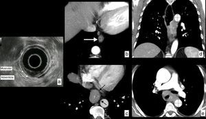 Cáncer de esófago, valoración de la infiltración de la pared (cT) en distintos pacientes. a) Ecoendoscopia en paciente con carcinoma epidermoide en el tercio medio del esófago que invade la mucosa y la submucosa, sin sobrepasarla, respetando la capa muscular: T1b según la clasificación TNM actual. b) TC en corte axial de otro paciente que muestra una pequeña lesión polipoidea de crecimiento endoluminal dependiente de la pared esofágica (flecha). Tras la resección quirúrgica, el estudio histológico confirmó que el tumor respetaba la capa muscular: T1 según la clasificación TNM actual. c) Corte axial de TC que muestra un tumor (T) del tercio inferior del esófago que infiltra los tejidos periesofágicos, pero que muestra en todo momento un plano graso con las estructuras vecinas (flechas negras), descartando infiltración de estas: T3 según la clasificación TNM actual. d) TC en reconstrucción coronal y corte axial (e) de otro paciente con tumor (T) de tercio medio e inferior del esófago que se extiende más allá de la pared y muestra amplio contacto con la aorta descendente, en más de 90° (líneas discontinuas), que sugiere radiológicamente infiltración de esta: T4b (irresecable) según la clasificación TNM actual.