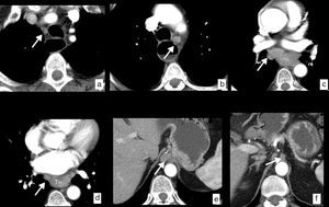 Cáncer de esófago, con diseminación ganglionar en estudios de TC (cN). Imágenes axiales en las que se identifican ganglios patológicos (flechas) secundarios a la extensión ganglionar en diferentes cadenas locorregionales mediastínicas y abdominales superiores. a) Cadena paratraqueal superior derecha (2R). b) Cadena paratraqueal inferior izquierda (4L). c) Cadena subcarinal (7). d) Cadena paraesofágica media (8M). e) Cadena paracardial (16). f) Cadena celiaca (20). Engrosamiento de la pared en el tercio medio del esófago (T) en relación con el tumor primario (d).