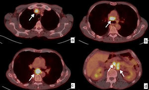 Recidiva ganglionar local y a distancia. Diagnóstico mediante PET-TC. Paciente con diagnóstico inicial de carcinoma epidermoide de tercio inferior de esófago torácico que fue intervenido quirúrgicamente con estadificación patológica pT3pN2. Imágenes axiales en el estudio de seguimiento, 6 meses después de la cirugía. Ganglios patológicos (flechas blancas) aumentados de tamaño y con incremento de la captación del trazador, con un SUV máximo entre 11.61 y 9.64, en las cadenas mediastínicas, que indican recidiva ganglionar local (a, b, c), y retroperitoneales superiores, pre y paraaórtica izquierda, en relación con recidiva a distancia (M1) (d).