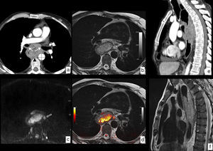 RM en cáncer de esófago con infiltración local. Neoplasia en tercio superior y medio del esófago con biopsia de carcinoma epidermoide. a) TC en corte axial en la que se identifica la lesión esofágica que contacta con la pared posterior de ambos bronquios principales (flechas), con la aorta descendente en más de 90° (líneas discontinuas) y con los cuerpos vertebrales (punta de flecha), sin identificar plano graso con dichas estructuras, lo que radiológicamente plantea infiltración local, en este caso irresecable. b) RM en corte axial a la misma altura potenciada en T2, que muestra la mayor resolución tisular de la técnica, lo que permite demostrar la ausencia de infiltración de las estructuras descritas y además muestra un ganglio patológico (flecha hueca) no identificado en el estudio con TC. c) RM potenciada en difusión a la misma altura que aporta información funcional, demostrando una alta señal con valor de b de 1.000 s/mm2, que indica restricción de la difusión del agua en la lesión tumoral y la presencia del ganglio paraesofágico antes referido. d) Imagen de fusión T2-difusión que incluye información anatómica y funcional conjuntamente. Comparación de la mayor resolución de contraste tisular de la RM (f) frente a la TC (e), en plano sagital, descartando infiltración de cuerpos vertebrales. Estadificación clínica final T3 N2-3 M0, que se desestimó para tratamiento quirúrgico y el paciente fue tratado con quimiorradioterapia definitiva.