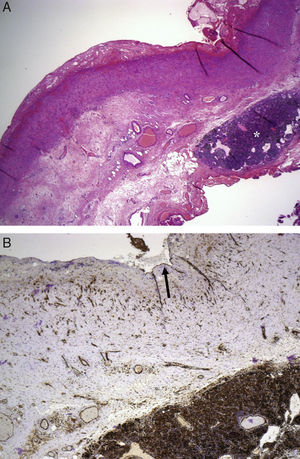 A) Sección de la pared del quiste, en la que se aprecia un ganglio linfático en su espesor (asterisco). B) Tinción de CD31 que pone de manifiesto el revestimiento endotelial (flecha).