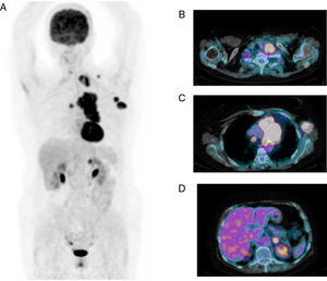 Tomografía por emisión de positrones PET-TC con 18F-FDG. Imagen MIP (proyección de máxima intensidad) (A) e imágenes de fusión PET-TC (B, C y D). Mujer de 62 años de edad remitida para estadificación de neoplasia de pulmón (T4N3M1b). Se observa una masa hipermetabólica polilobulada hiliar izquierda con infiltración de la pleura mediastínica. Múltiples adenopatías hipermetabólicas mediastínicas bilaterales, hiliar izquierda y supraclavicular. Metástasis ganglionares (axilares izquierdas) y suprarrenal izquierda.