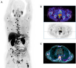 Tomografía por emisión de positrones PET-TC con 18F-FCH. Imagen MIP (proyección de máxima intensidad) (A). Imágenes de fusión PET-TC y PET (B). Imagen de fusión PET-TC (C). Varón de 67 años de edad remitido para estadificación de carcinoma de próstata Gleason 4+3. Se observan varios depósitos patológicos de actividad en la glándula prostática (B), así como múltiples lesiones hipercaptantes en el esqueleto axial y apendicular compatibles con metástasis óseas (A y C).