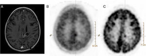 Corte axial de resonancia magnética cerebral en T1 con contraste (A) y cortes axiales de tomografía por emisión de positrones con 11C-MET (B) y con 18F-FDG (C). Mujer de 41 años de edad remitida para realizar diagnóstico diferencial entre recidiva y radionecrosis de glioma cerebral. En la imagen A se aprecia una lesión sólido-quística adyacente al asta occipital del ventrículo lateral izquierdo con realce periférico tras la administración de gadolinio. En los estudios B y C se observa un depósito de actividad en el polo sólido de la lesión ya conocida, compatible con una recidiva tumoral.